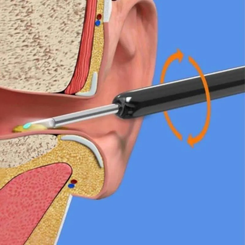 Visible wax elimination spoon load otoscope Ear Cleaner Ear wax removal tool Suitable for Android iOS phones